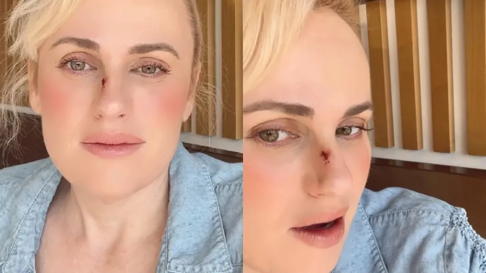 Rebel Wilson e o acidente no filme ‘Bride Hard’ que exigiu cirurgia