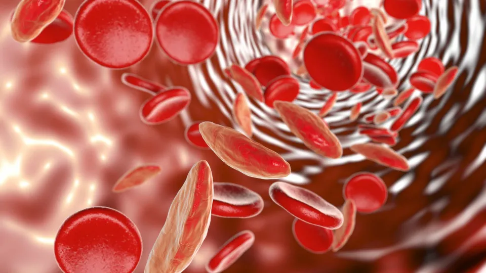 Sabe o que é anemia falciforme ou drepanocitose? Saiba os sintomas