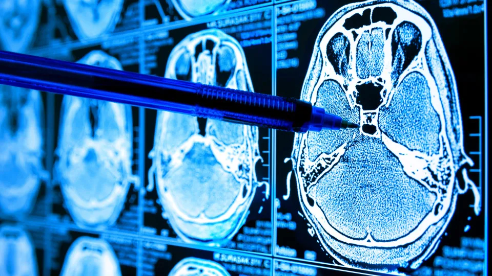 Descoberta sobre glicose no cérebro pode ajudar a combater Alzheimer