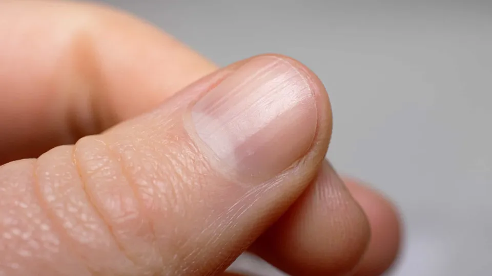 Alerta: dermatologista revela o que podem significar riscos nas unhas Alerta: dermatologista revela o que podem significar riscos nas unhas