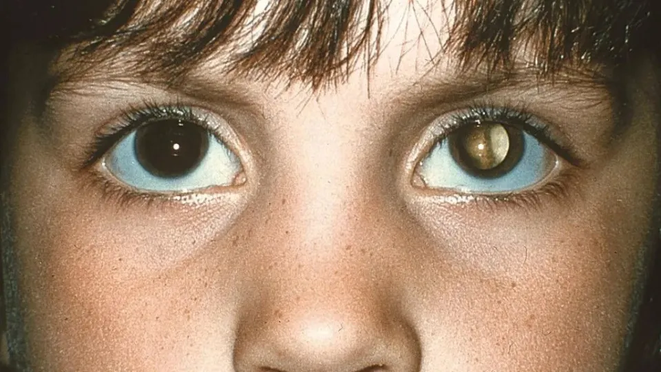 Cuidados na infância: ‘olhos brancos’ após tirar foto pode indicar tumor