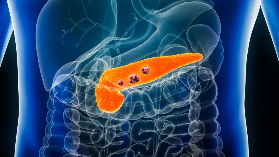 Casos de pancreatite após uso de canetas emagrecedoras são raros, dizem especialistas
