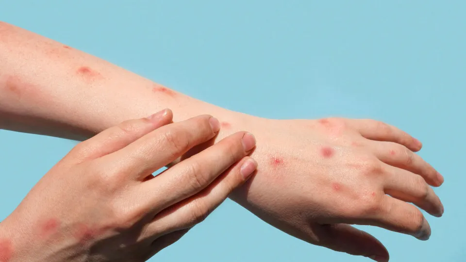 Mpox: veja como identificar sintomas e prevenir a transmissão doméstica